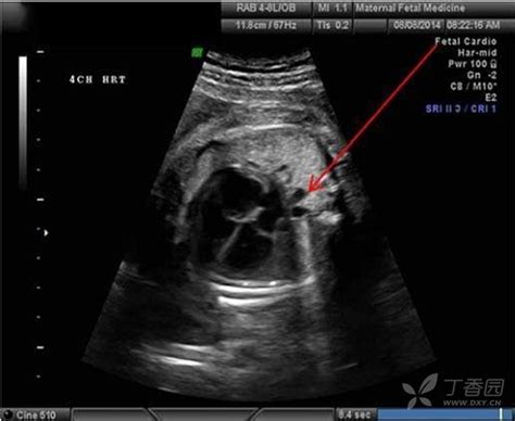 b超胎儿左心室强光点