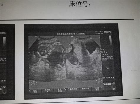 胎儿十周未见胎心