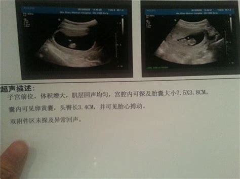 孕八周胎儿b超真实图