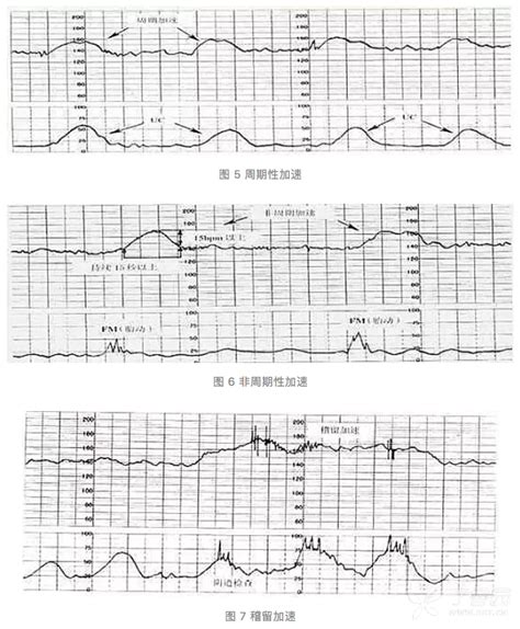 胎心监测曲线图不连续