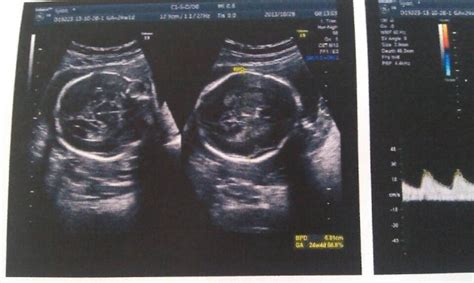 孕9个月四维彩超图片