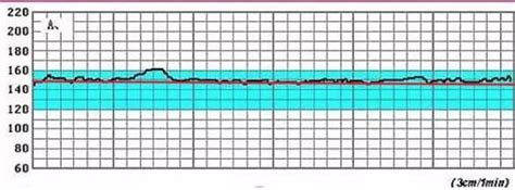 如何看胎心监护曲线图