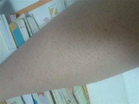 腰部出红疙瘩怎么回事