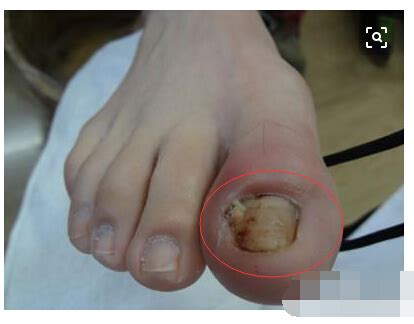 脚趾甲有一条黑线是什么问题