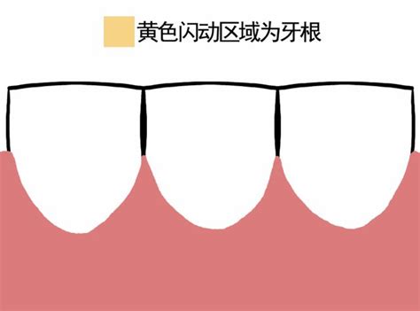 假牙套裂缝图片