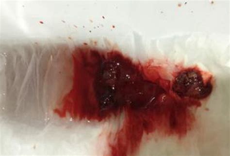 茄子型孕囊一般比例是多少