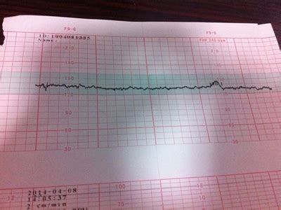 胎心监护的曲线怎么看才算正常