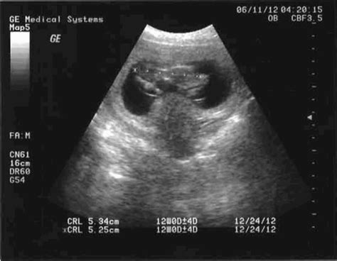 五个月男胎儿彩超图