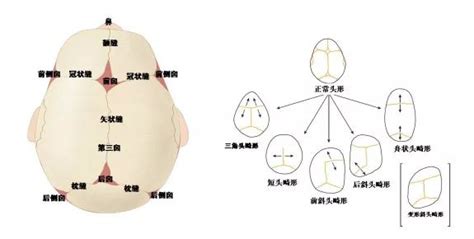 囟门早闭的儿童