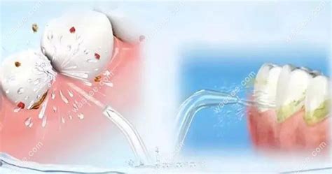 家用洗牙器能否把牙結(jié)石沖掉?