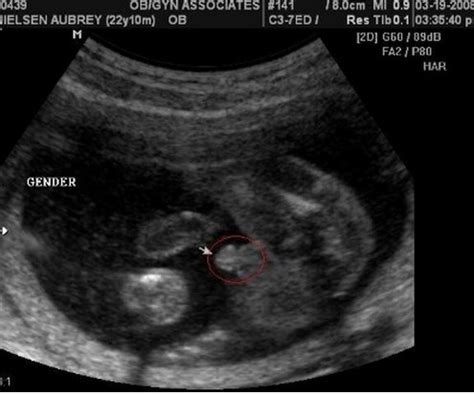 怀孕一个月胎儿图的大小