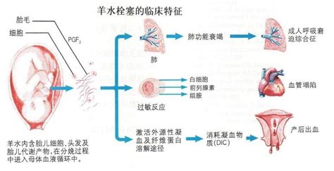 羊水穿刺对胎儿有伤害吗