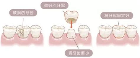 关于种牙纳入医保的建议