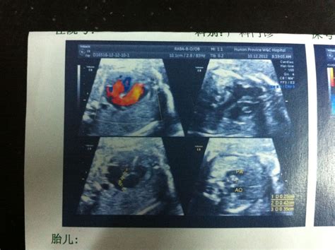 胎儿心脏右位主动脉弓严重吗
