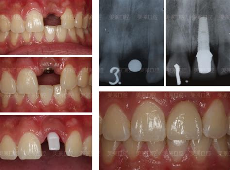 种植门牙效果图