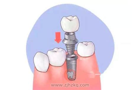 假牙有几种安装方法