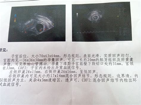 孕八周hcg26000