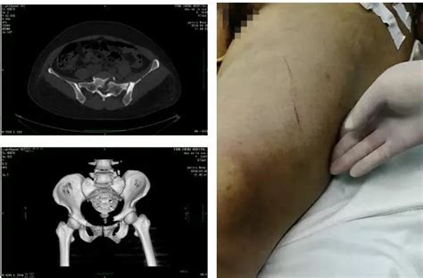右侧耻骨坐骨异常信号