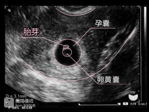 6周没胎心胎芽有卵黄囊