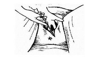 顺产侧切伤口疼痛怎么办