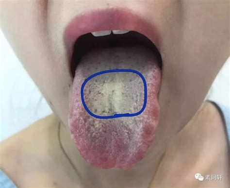 痰湿舌苔图片