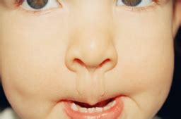 8岁小孩流清鼻涕最快的治疗方法