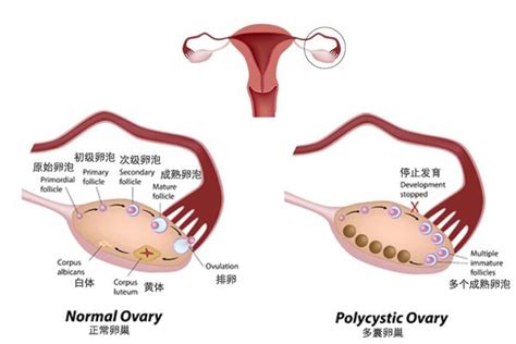 多囊卵巢样改变和多囊卵巢综合症的区别