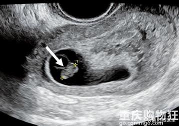 怀孕6周看见胎心胎芽