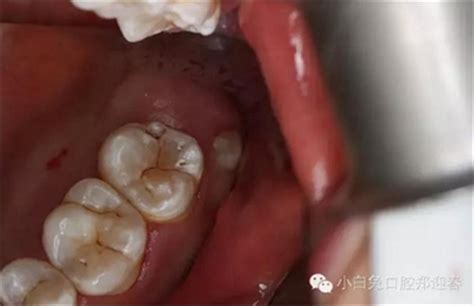 拔牙全过程模拟