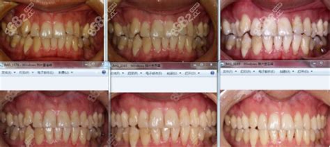 杭州牙齿矫正医院排名