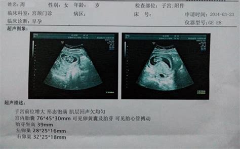 怀孕初期 b超图片