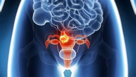 多囊卵巢综合征要注意什么