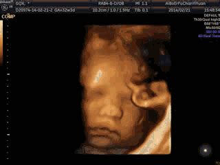 胎儿畸形的监测