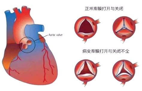 复杂性先心病是怎么回事