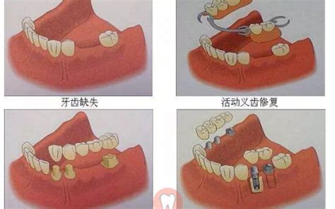 哪种假牙材料对身体没有危害