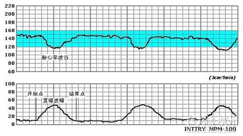 缺氧的胎心监护曲线图