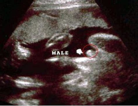 一张B超单竟能判断胎儿性别