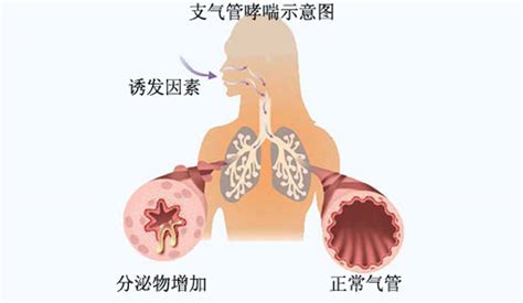 支气管扩张饮食方法