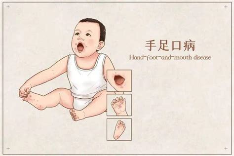 0-1岁宝宝的常见疾病有哪些