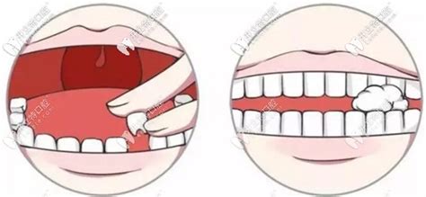 单个活动假牙怎么戴紧