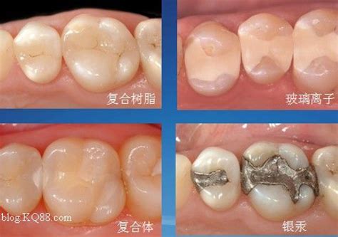 种植一颗大牙大概需要多少钱一颗