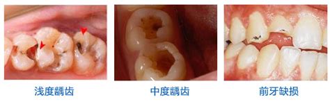 小孩拔牙能用绳子勒掉吗