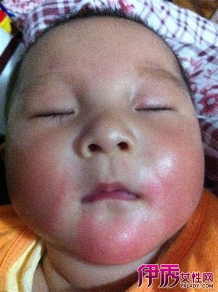 新生儿宝宝红臀怎么办