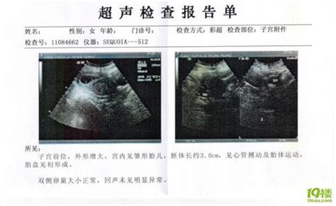 孕囊大小与胎芽大小对照表