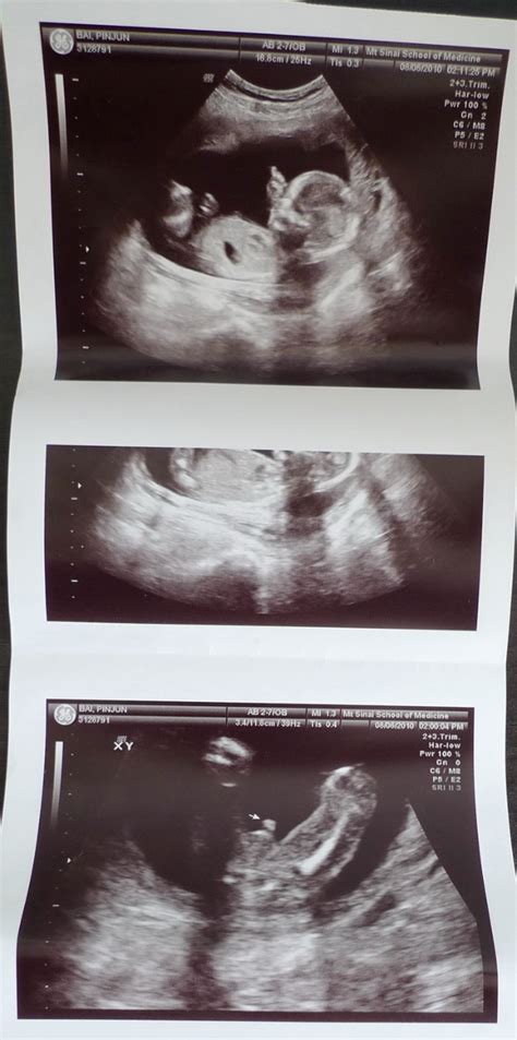 怀孕14周的彩超图