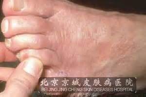 手足癣的症状和治疗方法