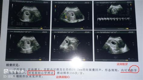 明明怀孕6周为什么b超显示5周