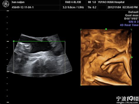 24周胎儿彩超照片