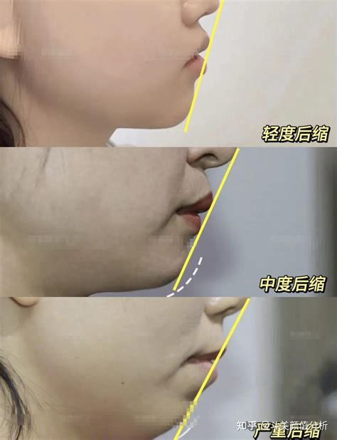 下巴后缩是怎么引起的
