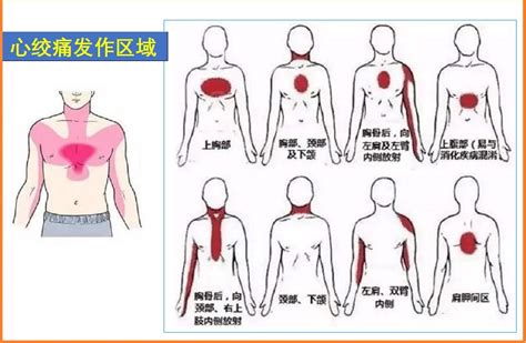 心绞痛发生的典型部位是剑突还是